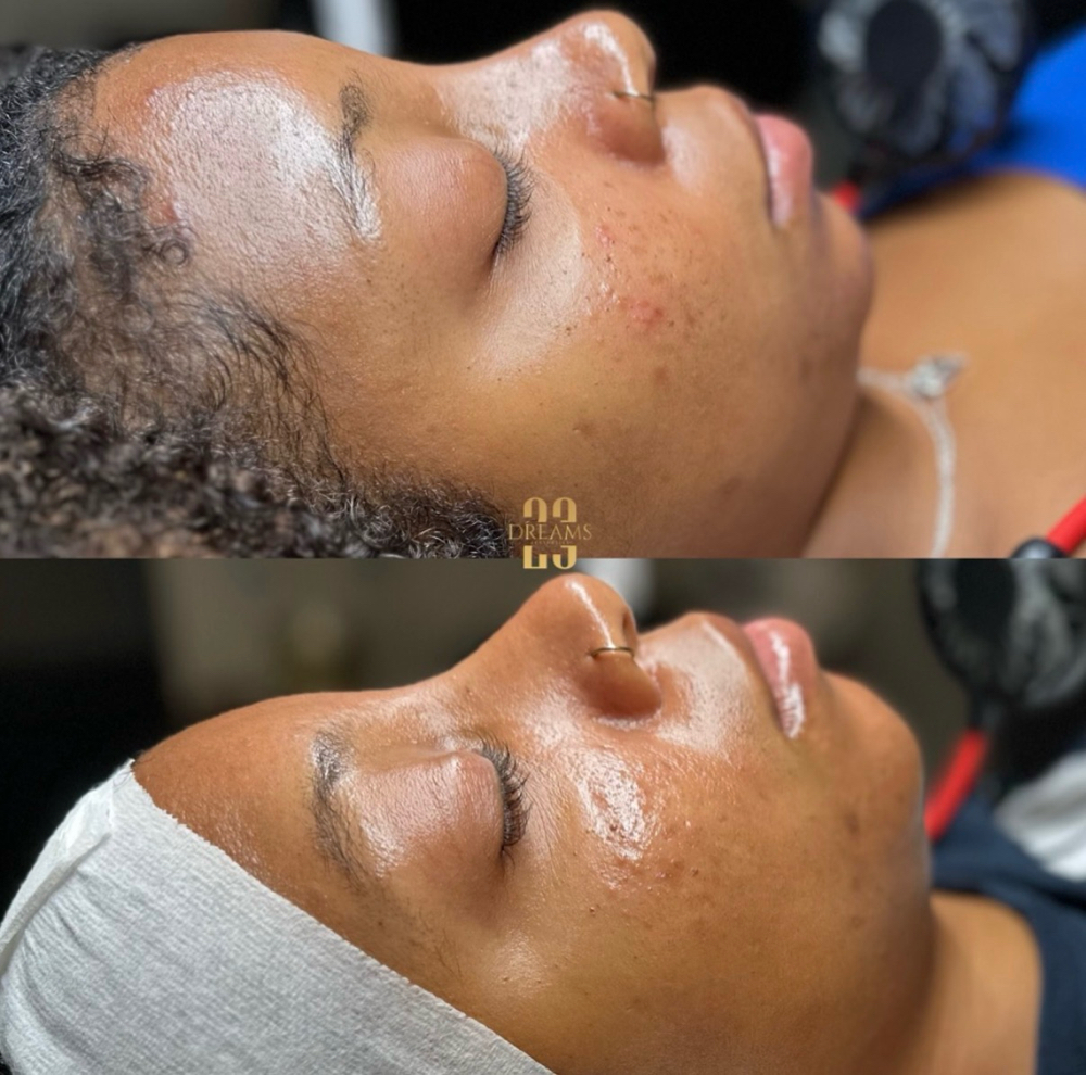 CLEAR DREAM ACNE FACIAL at 23 Dreams Aesthetics in Minotola, NJ
