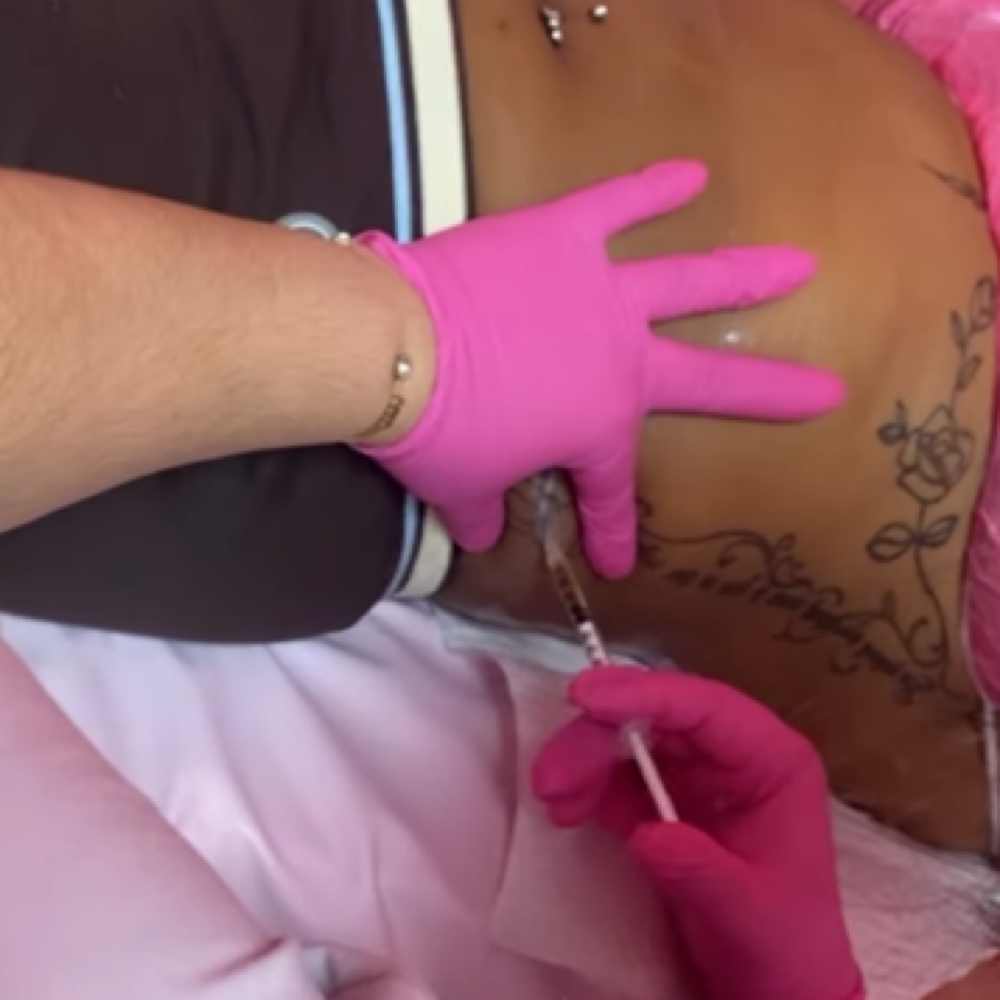 Back Rolls Fat Dissolve at Finesse Sculpt Body Studio in Parkville, MD