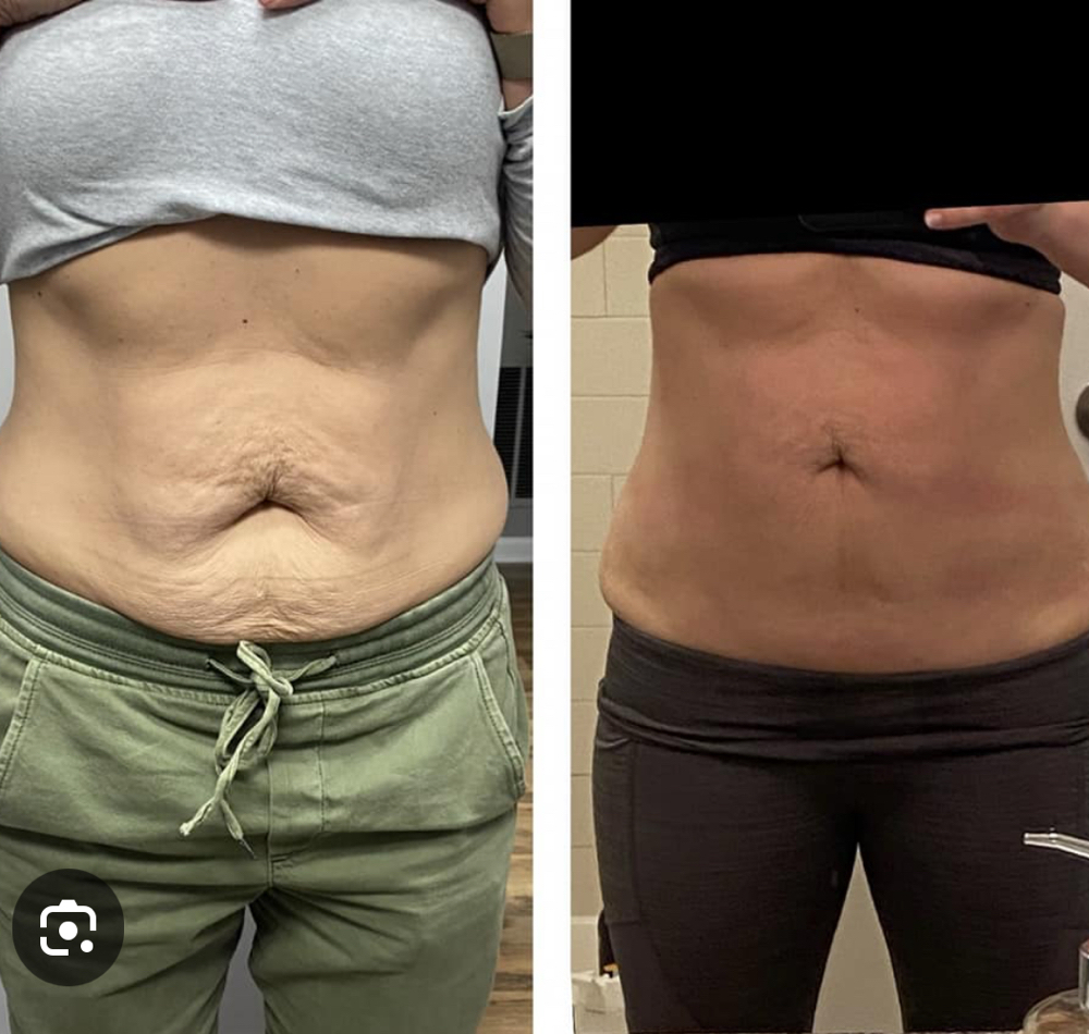 Cryo T - Core Renewal