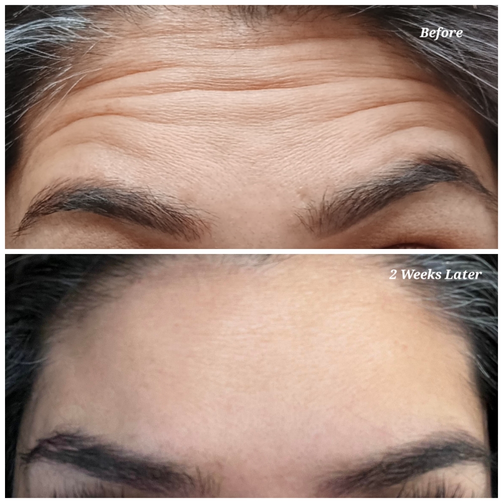 Forehead (Botox)