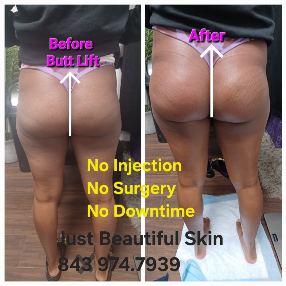 🍑4 Treatment Butt Lift Package at JUST BEAUTIFUL SKIN in Goose Creek, SC