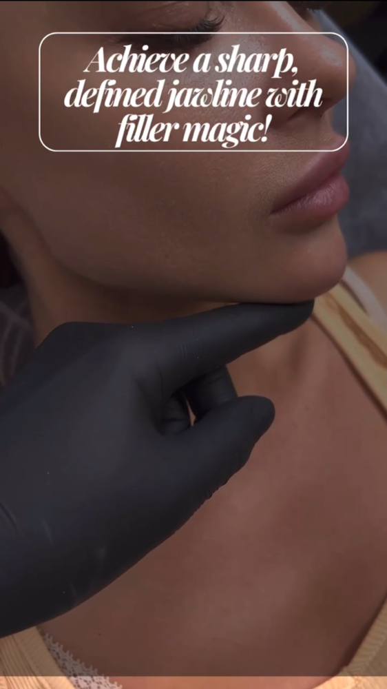 Jawline Filler