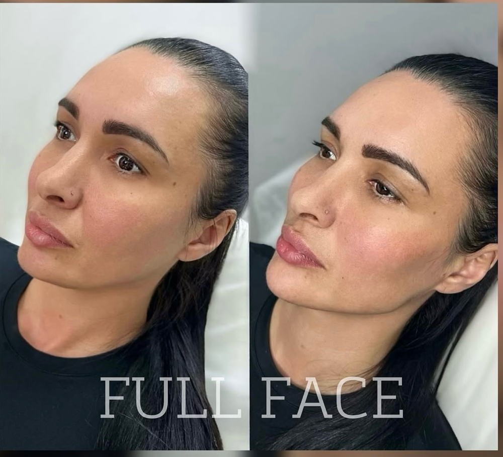 Full Face Filler Balancing