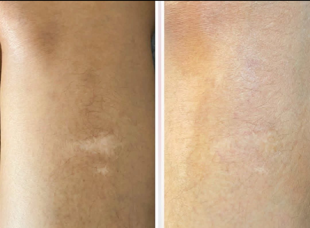 Inkless Scar Revision/Camo at Jens Ink Tattoo Studio in Sebring, FL