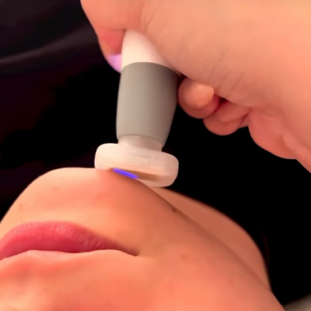 Jet Plasma Rejuvenation at LĀ BEAUTY in Wilmington, MA