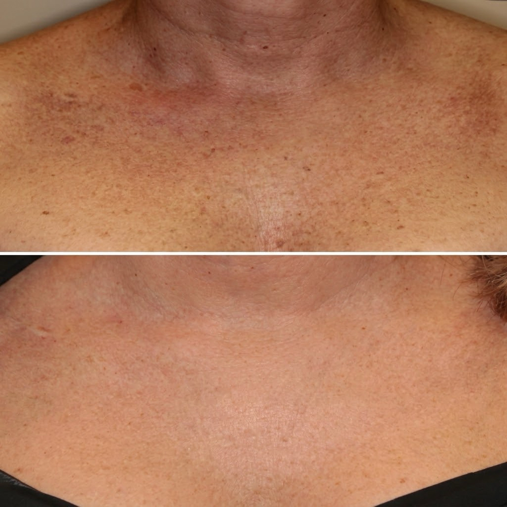 Chest SKIN TIGHTEN / RESURFACE at BEAUTY LAB COLLECTIVE in Miami, FL