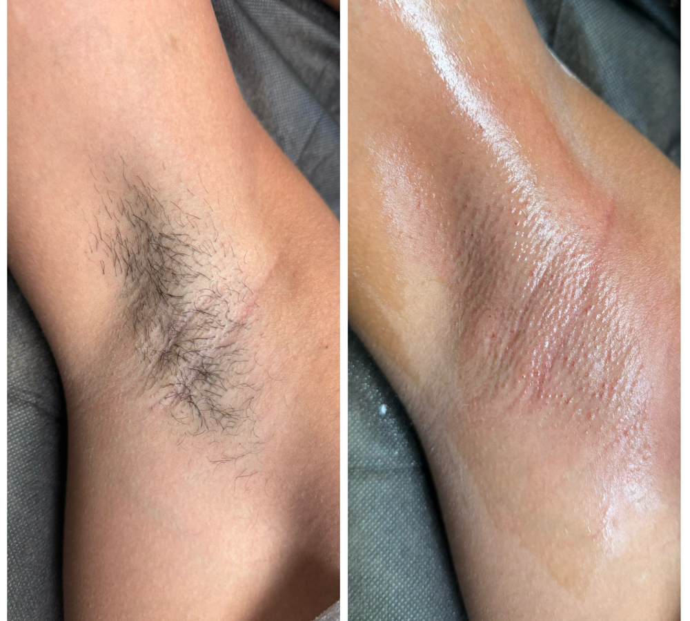 Underarm Wax at Ali Lanelle Esthetics in summerville, SC