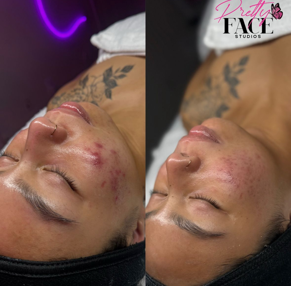 Acne Facial