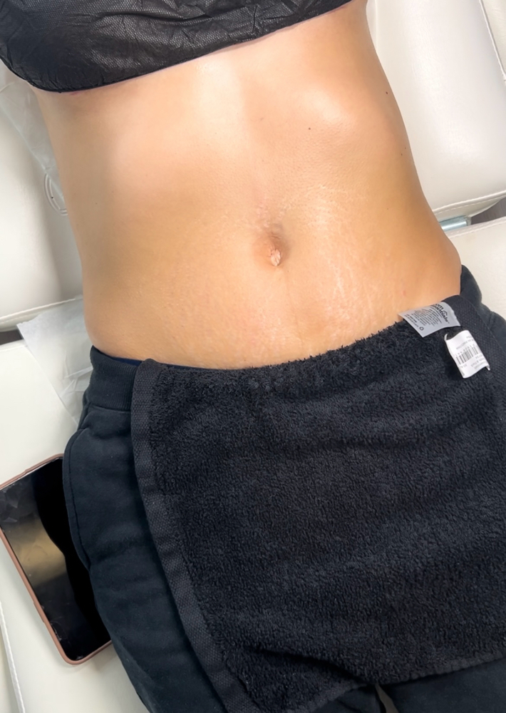 Brazilian Lymphatic Drainage 6 sess