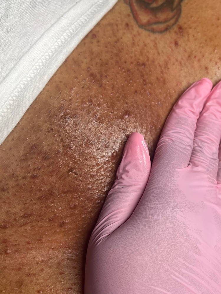 Brazilian + Underarm Duo at Kandi Esthetics in Meriden, CT