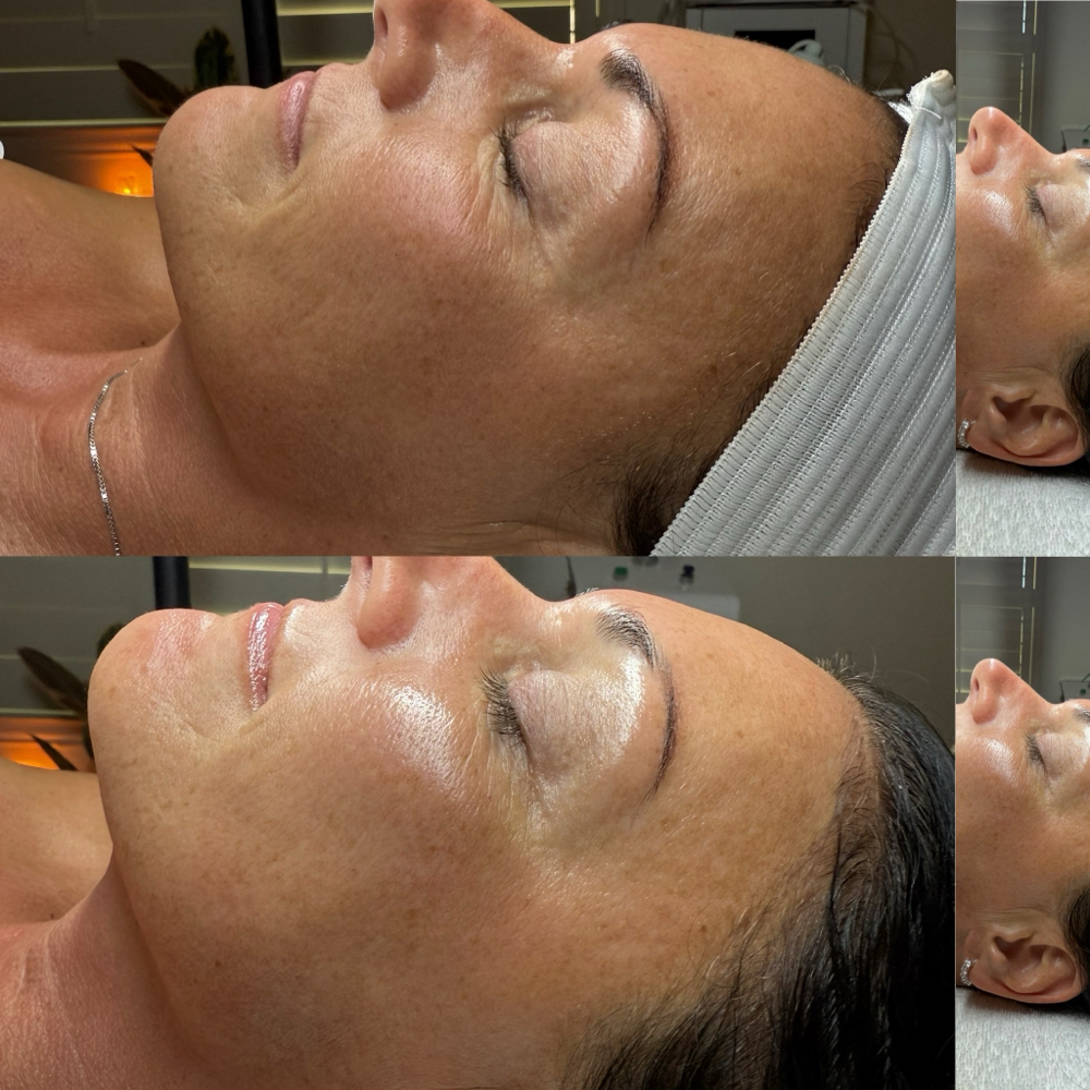 Botox Facial- Buy 2 get 20% off