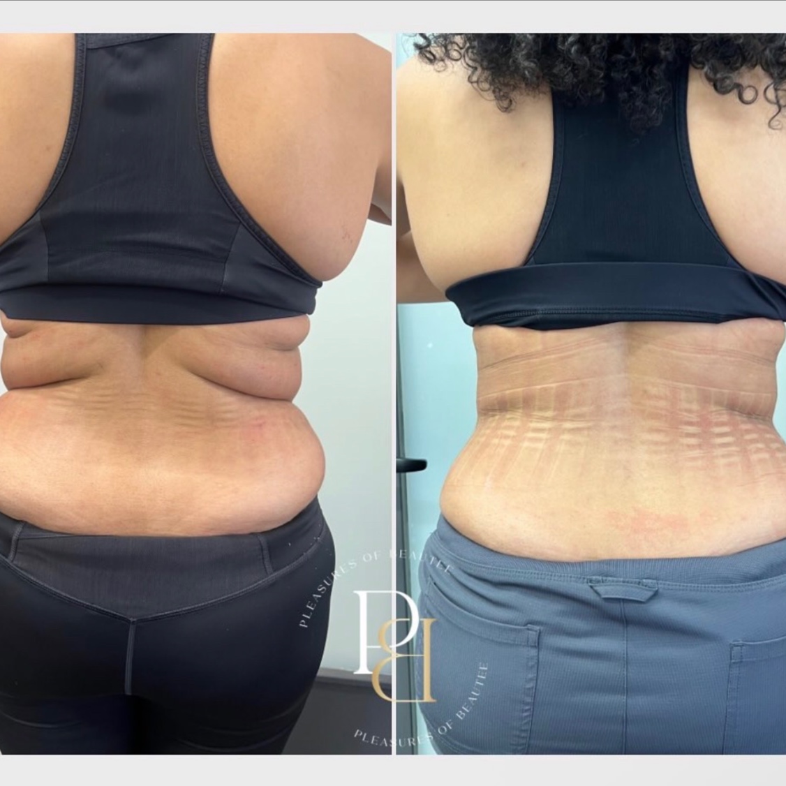 2-Area Fat Dissolving Injections at Pleasures of Beautee in Atlanta, GA