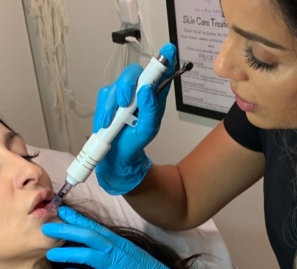 Hyaluronic Needless Lip Filler