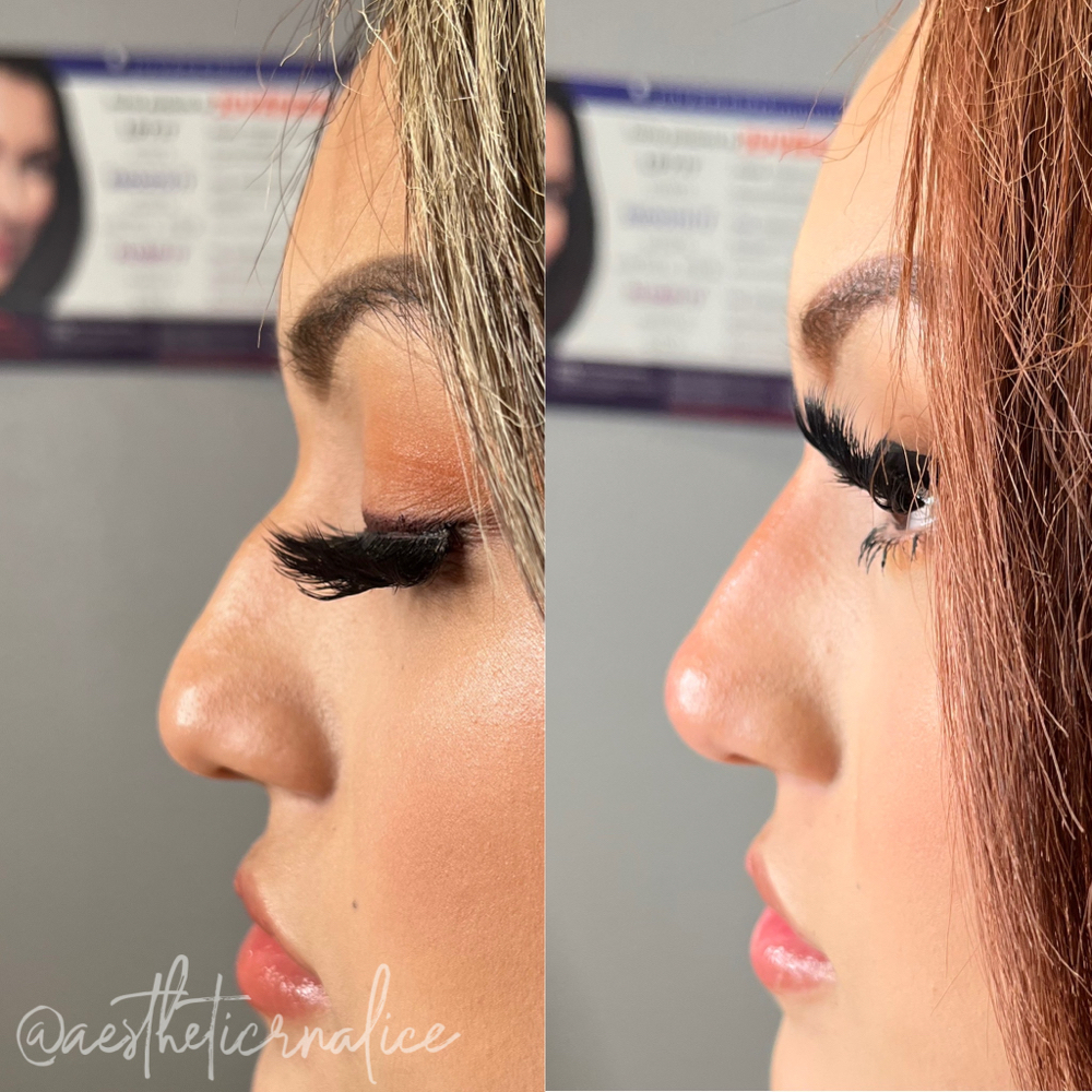 Liquid Rhinoplasty
