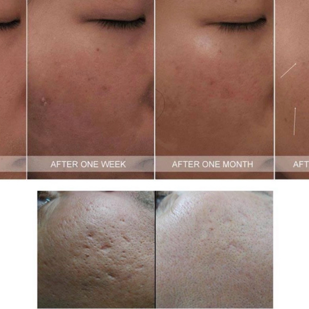 TCA Peel 20% at Alchemy Health Aesthetic Beauty LLC in Indianapolis, IN