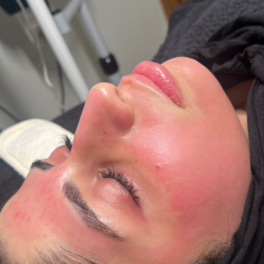 Salmon DNA Microneedling at Elite Beauty And Beyond in Worth, IL