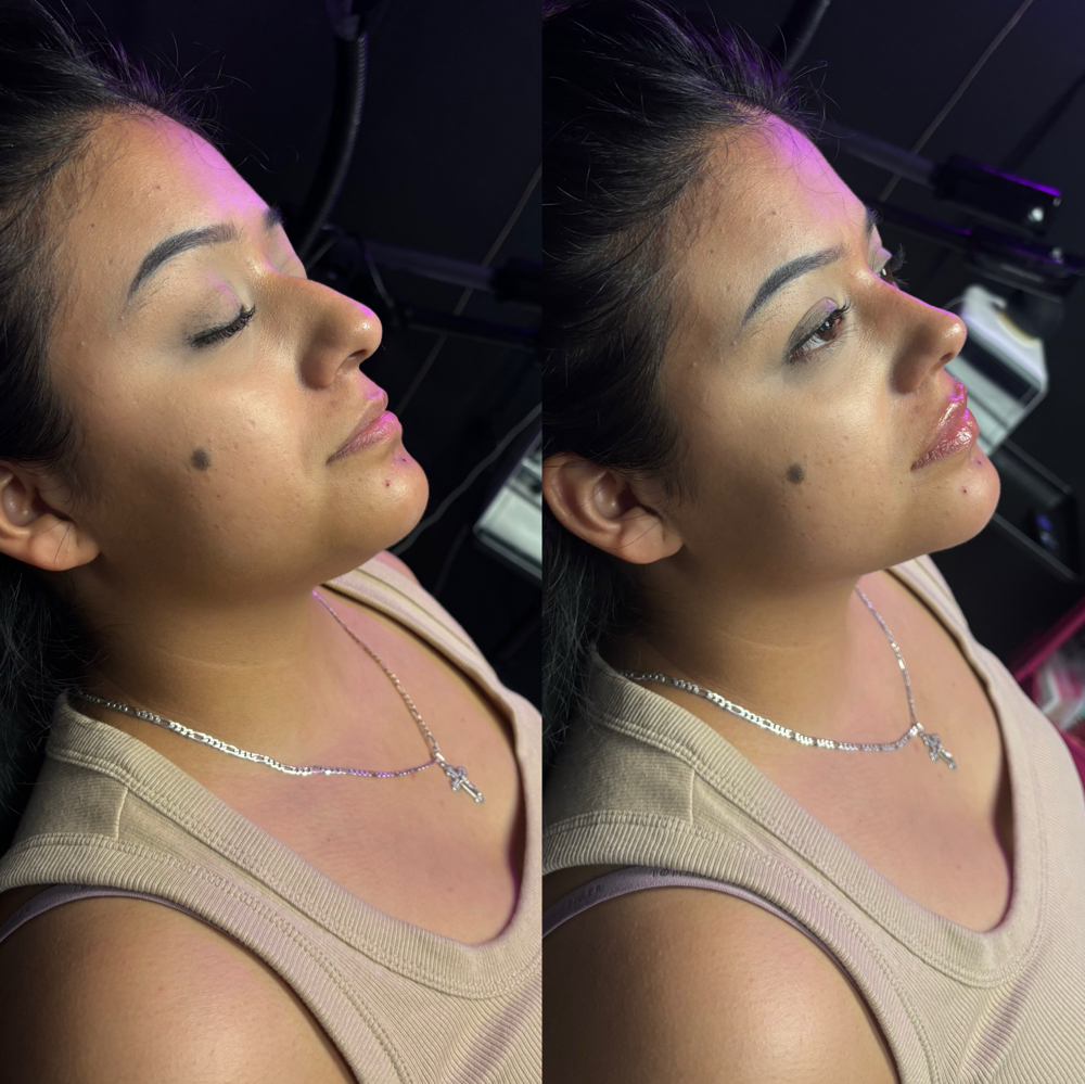 Liquid Rhinoplasty(Nose Filler) at Perfection Injections in Euless, TX