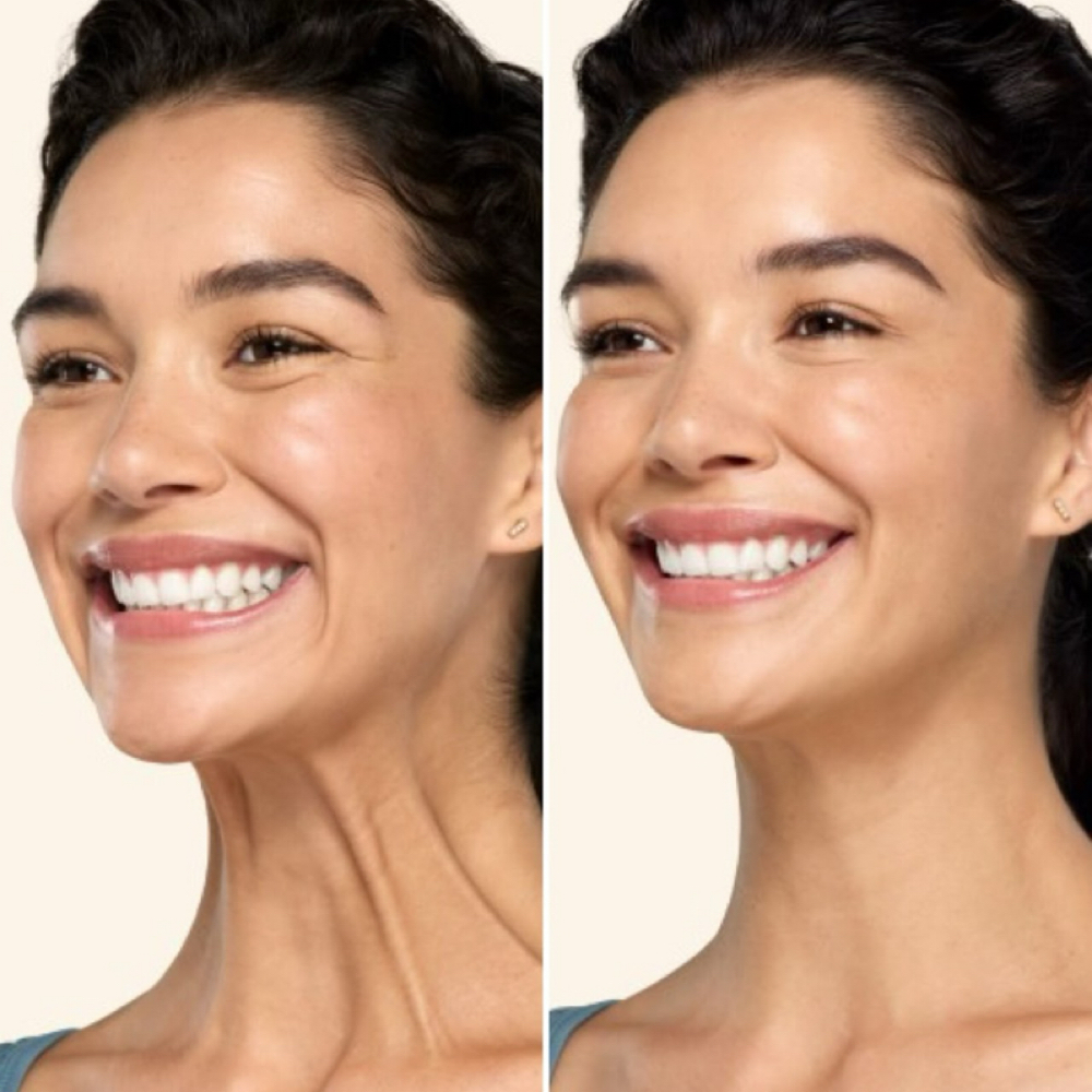 Neck Tightening Treatment at Refyned Aesthetics & Wellness in Greenville, TX
