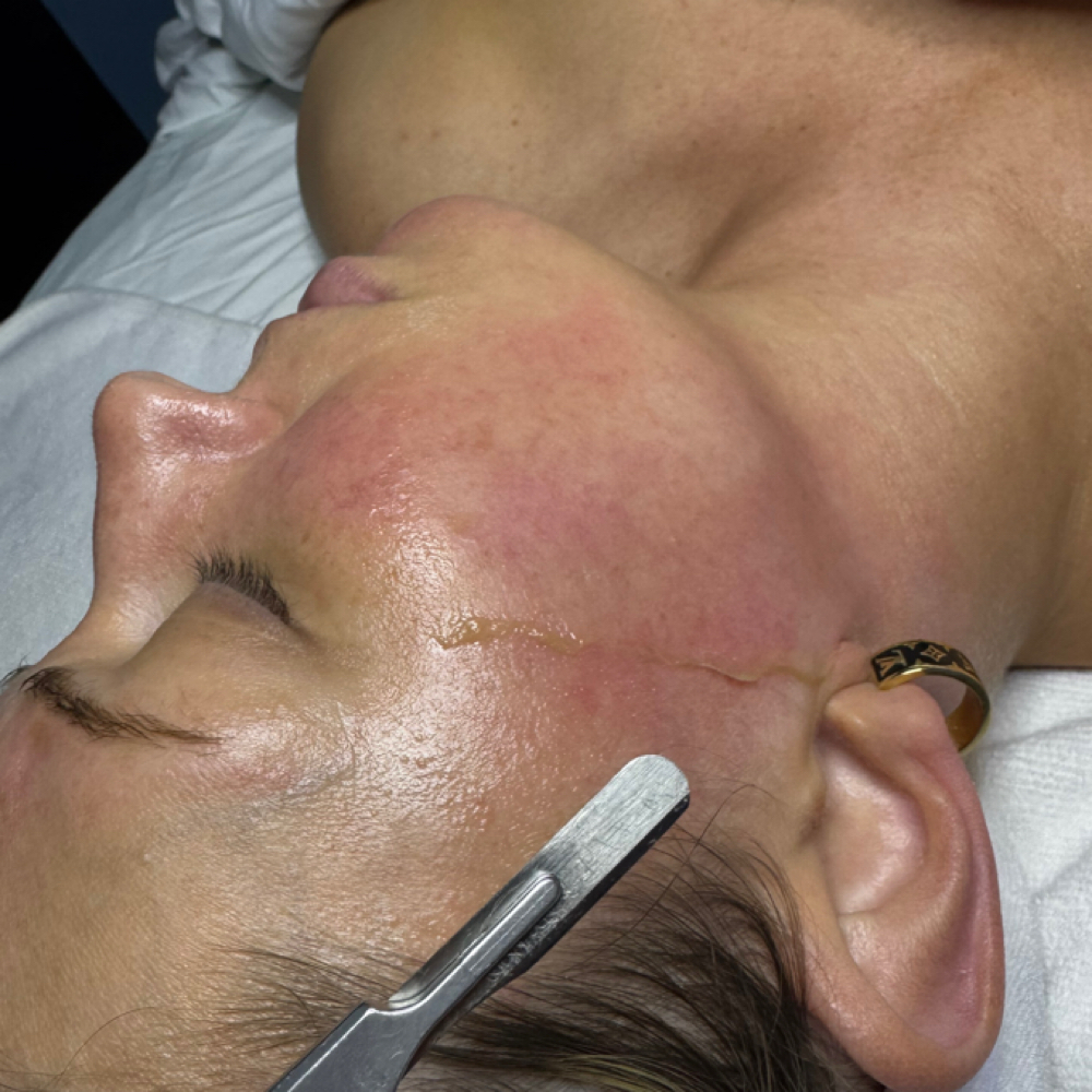 Express Dermaplane at Skinfinity & Beyond in Davidson, NC