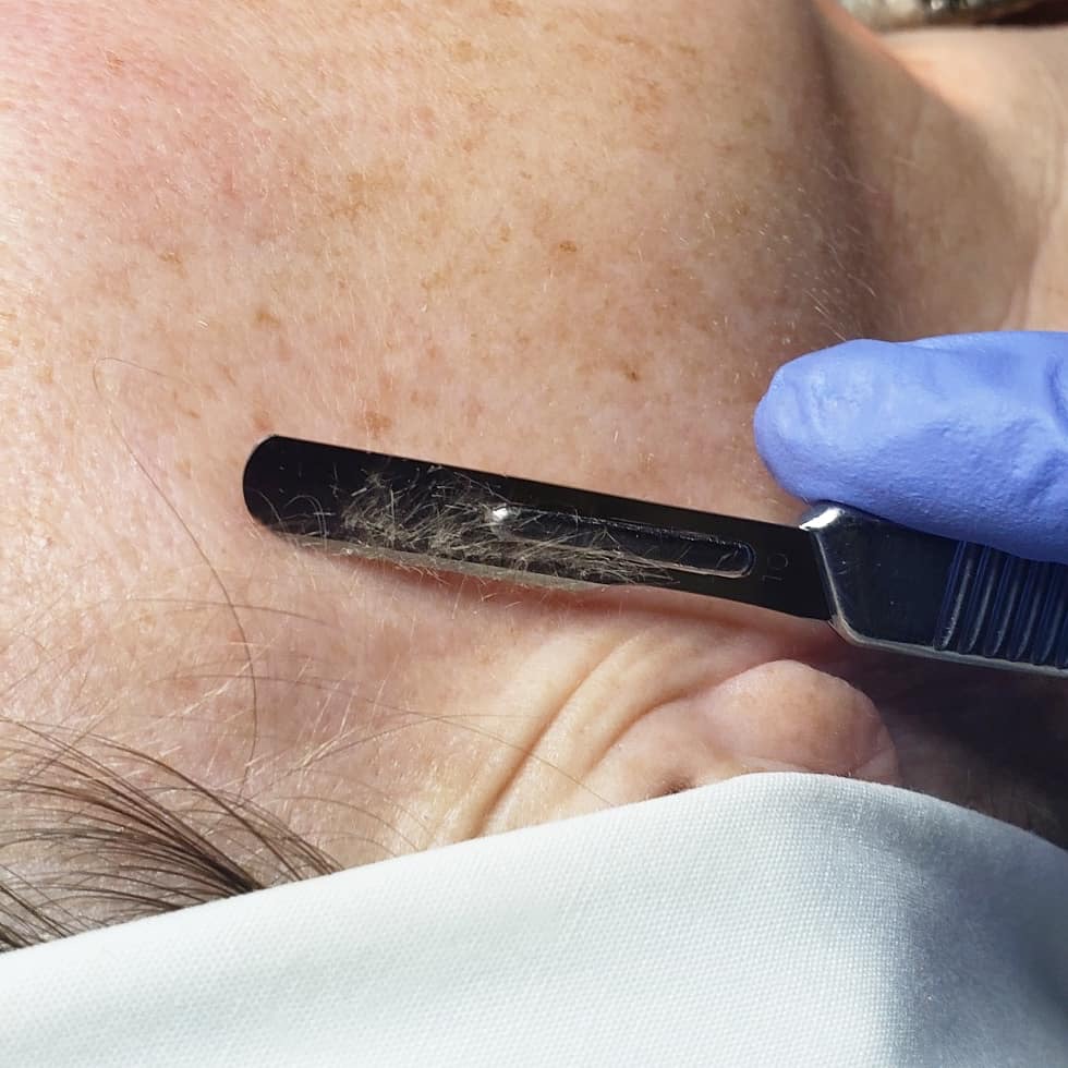 Express Dermaplane