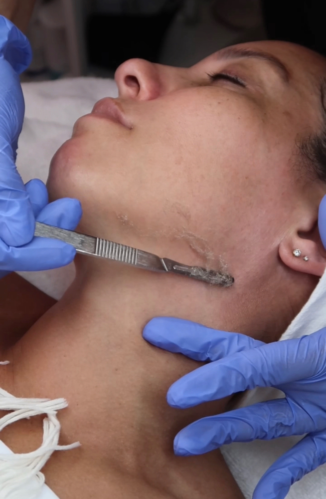 Dermaplane Facial