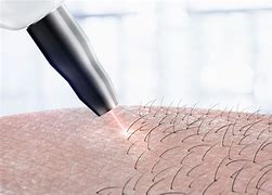 Chest-Laser Hair Removal