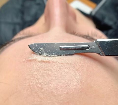 Facial add On - Dermaplane