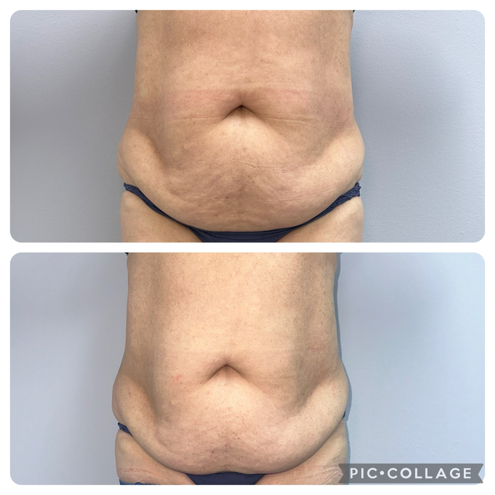 10 sessions Body Contouring