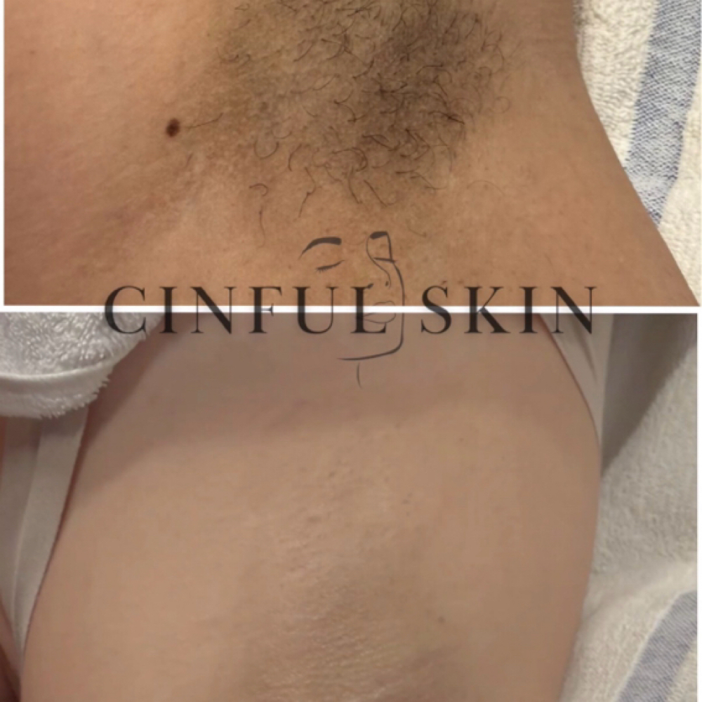 Underarm Lightening & Wax Special at Cinful Skin in San Diego, CA