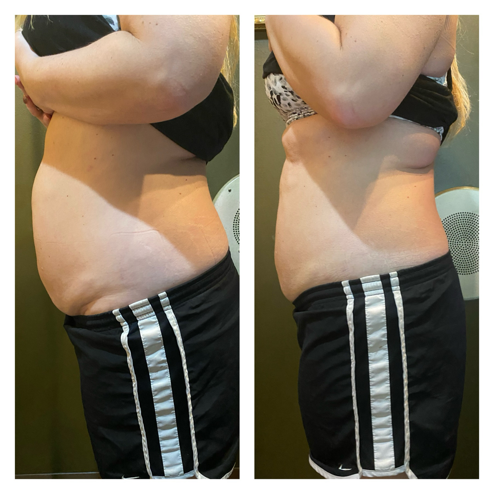 Belly Fat Targeting Treatment