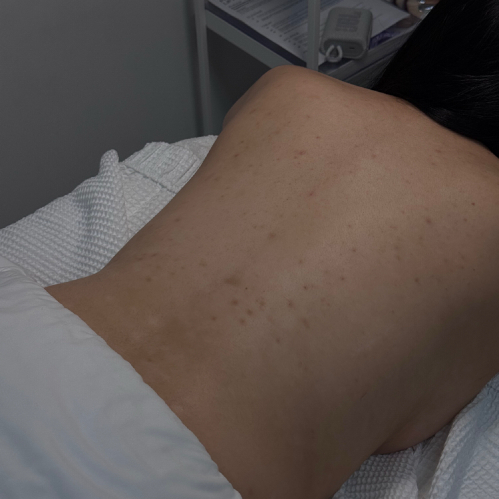 Back Facial at Lakutis Skin Therapy in Houston, TX