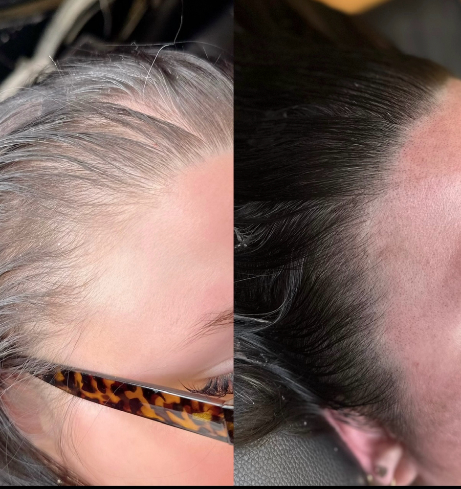 Scalp Micropigmentation