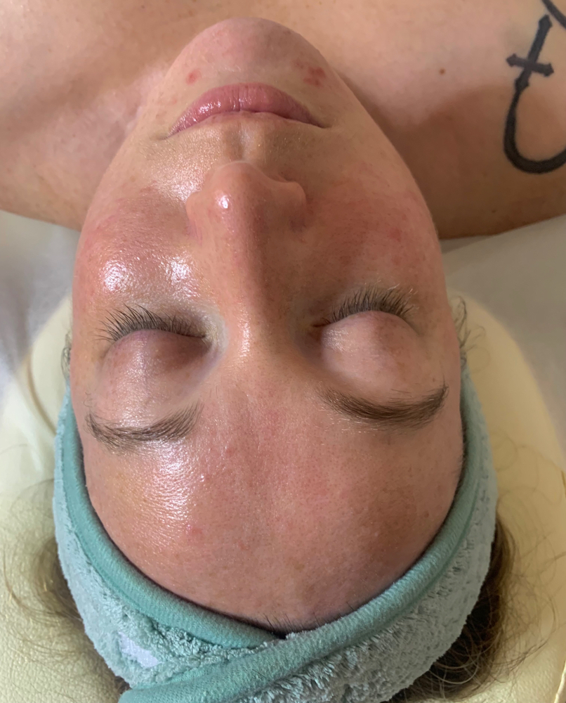 Acne Facial