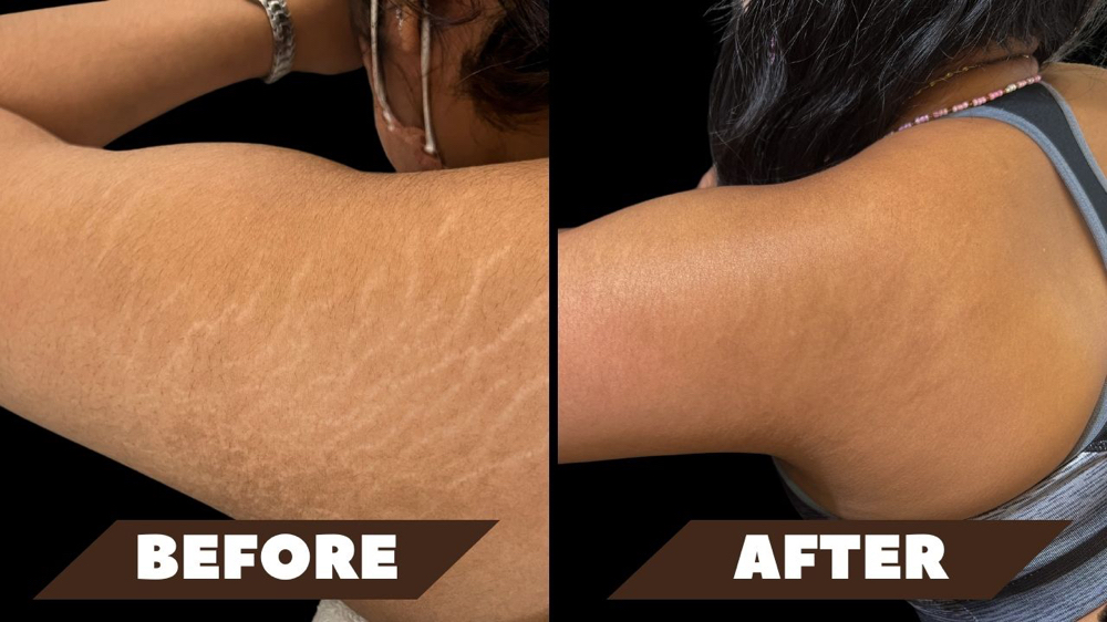 Inkless Scar Revision