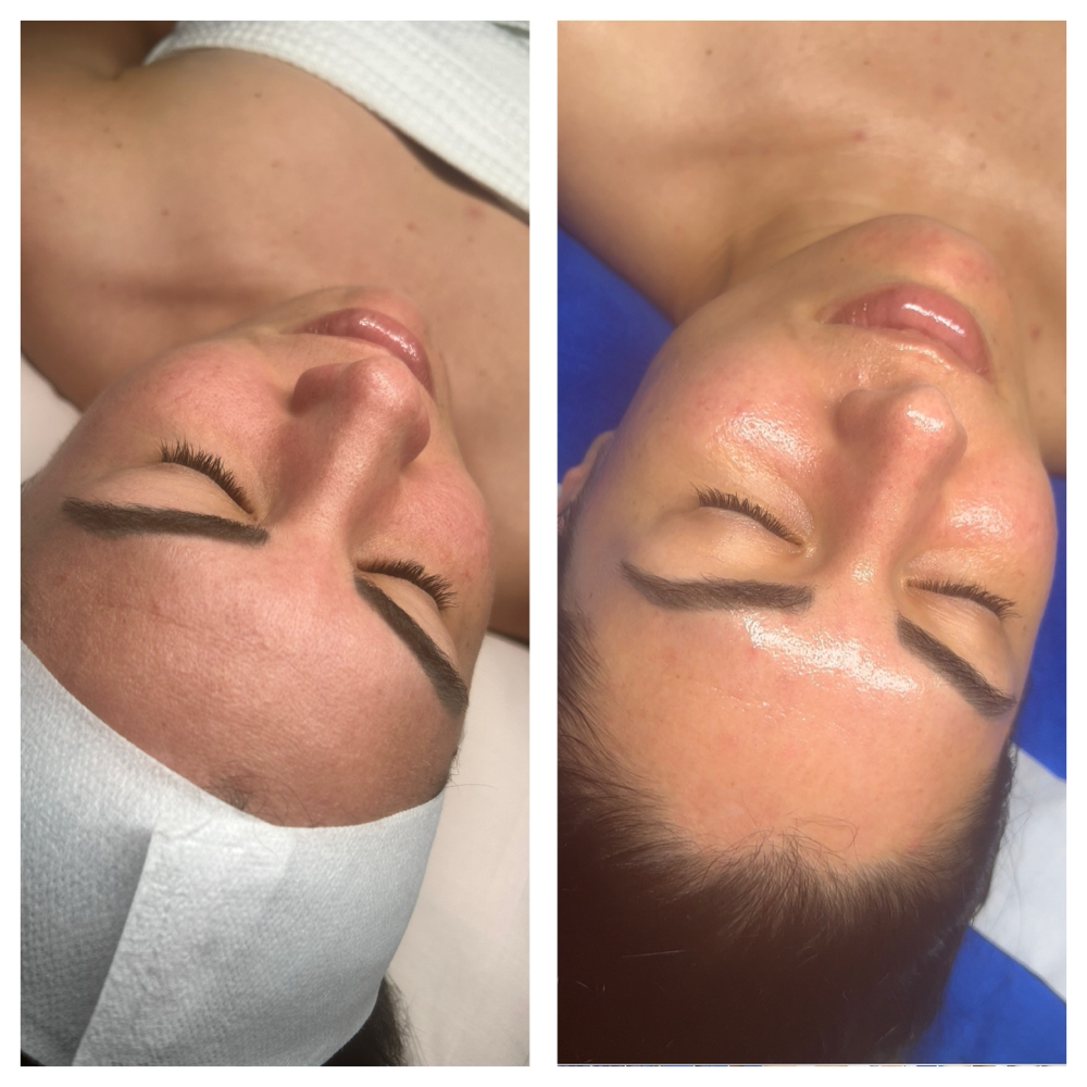 Collagen Booster Anti-Aging Facial