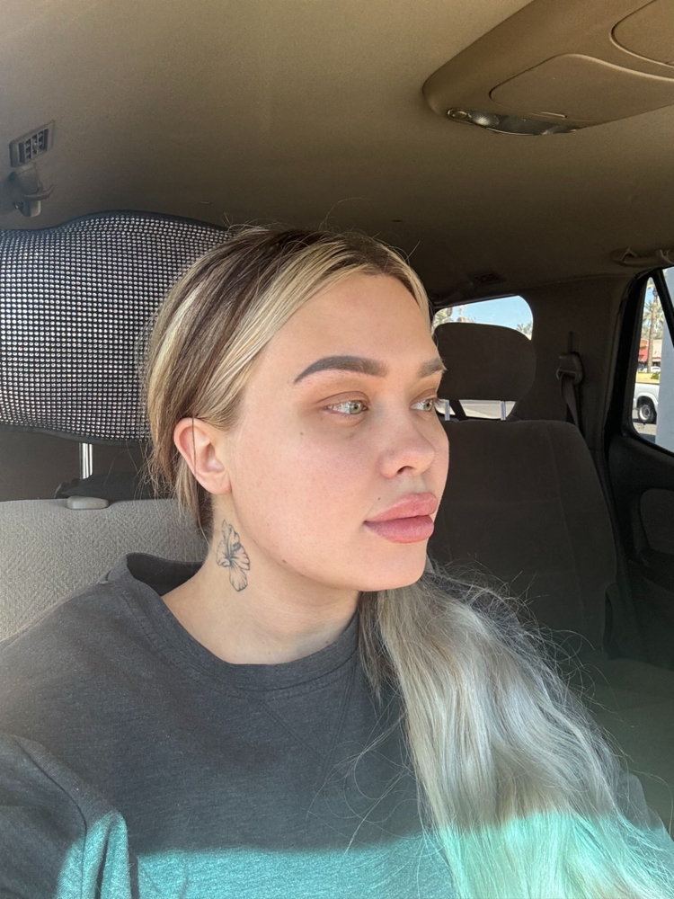 Masseters Botox
