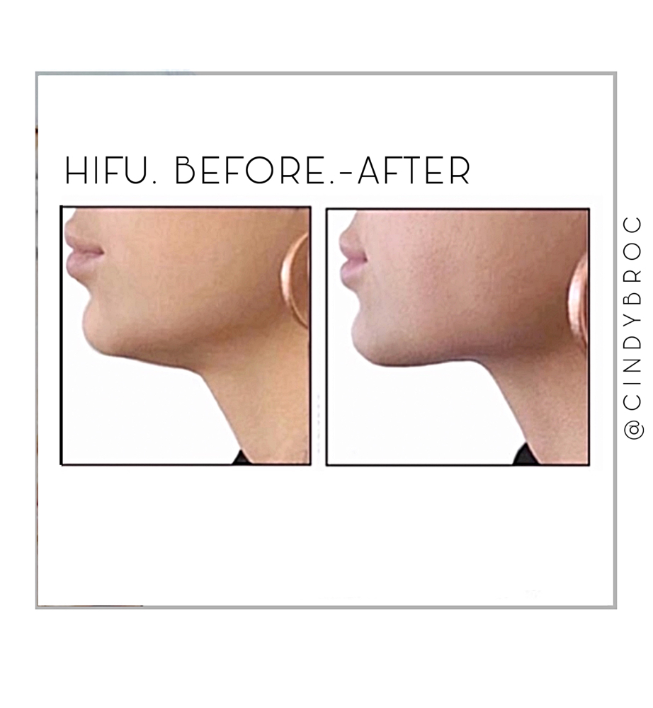 HiFu Trtmnt Under Chin/Neck Only