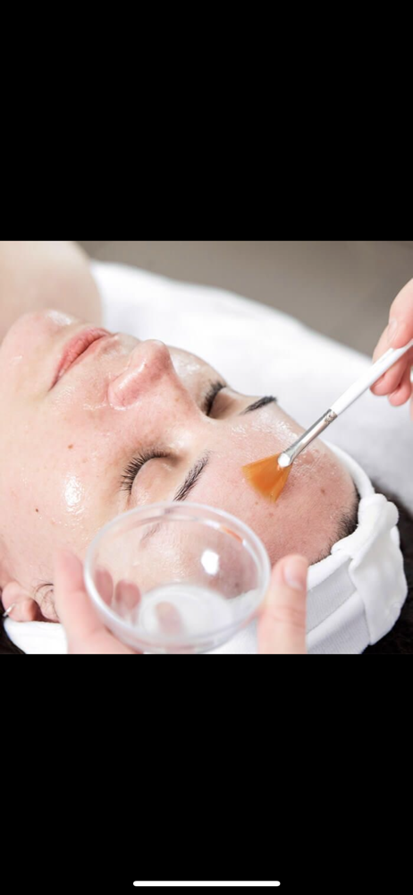 Chemical Peel
