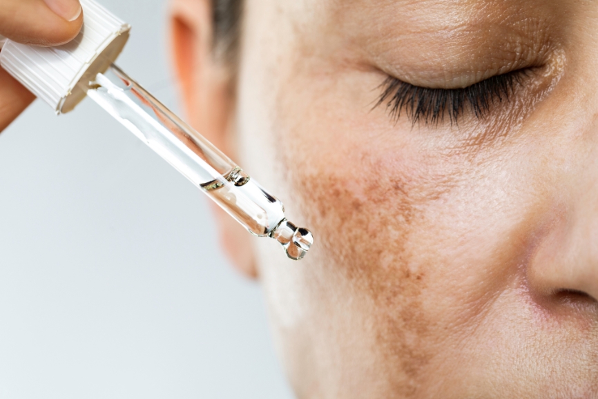 Facial Despigmentante at Ella’s Beauty Studio LLC in Denver, CO