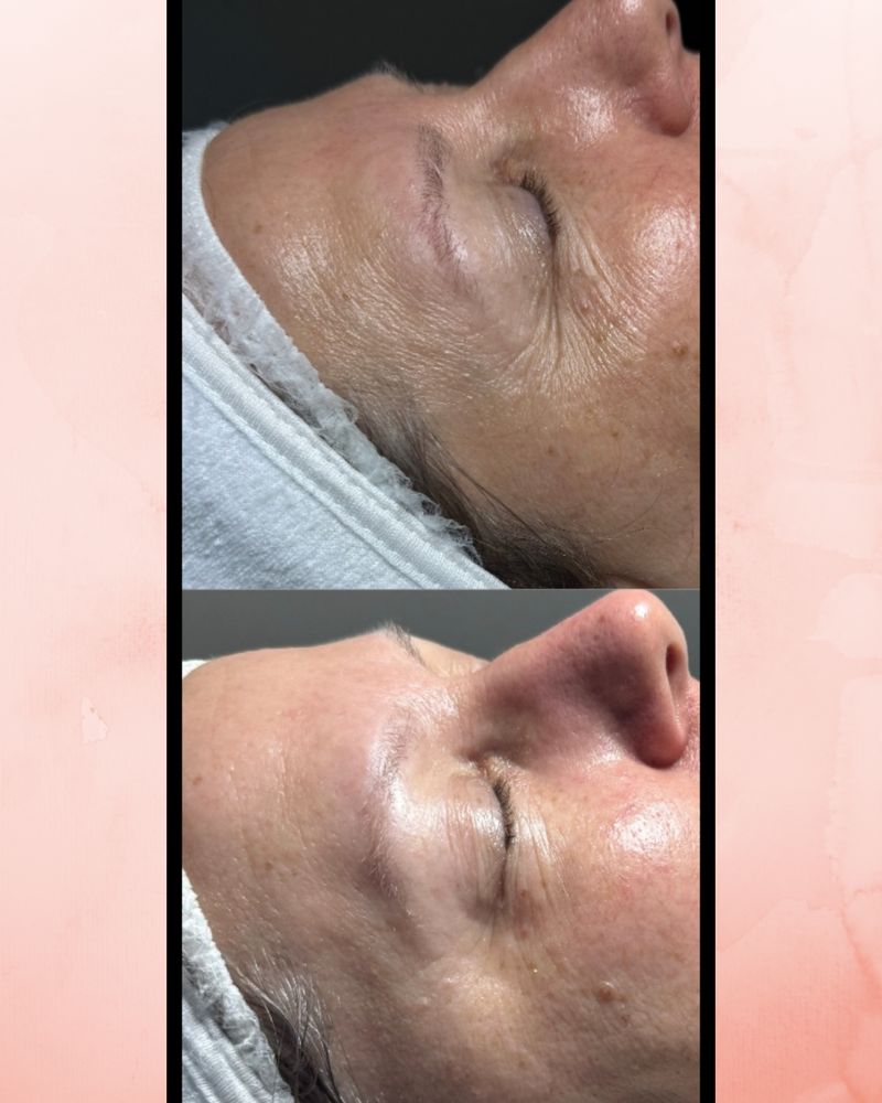 Luxury Lift Facial