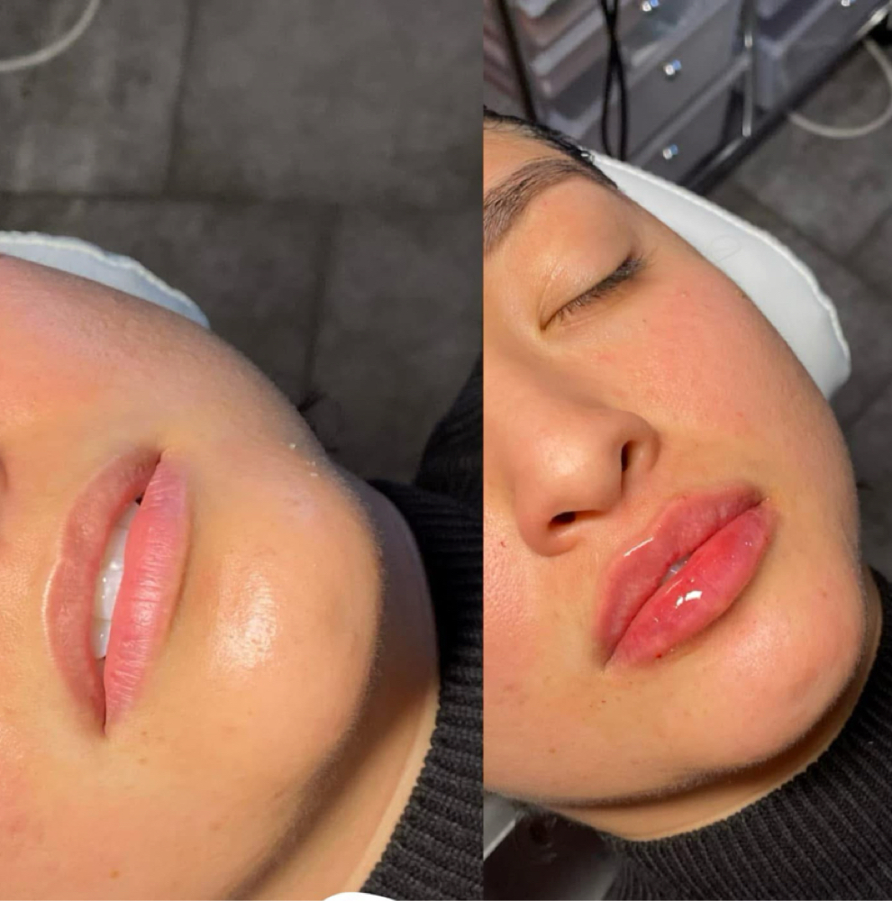 💎 Lip Filler – Half Syringe at Flawless Spa & Beauty in Fort Worth, TX
