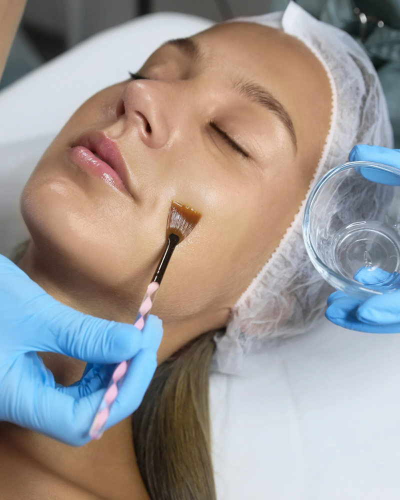 Chemical Peel (Face/chest)