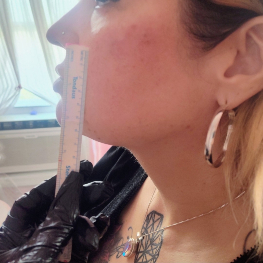 Lower Facelift LIPO Plus Cheek Fill at Boujee Artistry ✨ in Tucson, AZ