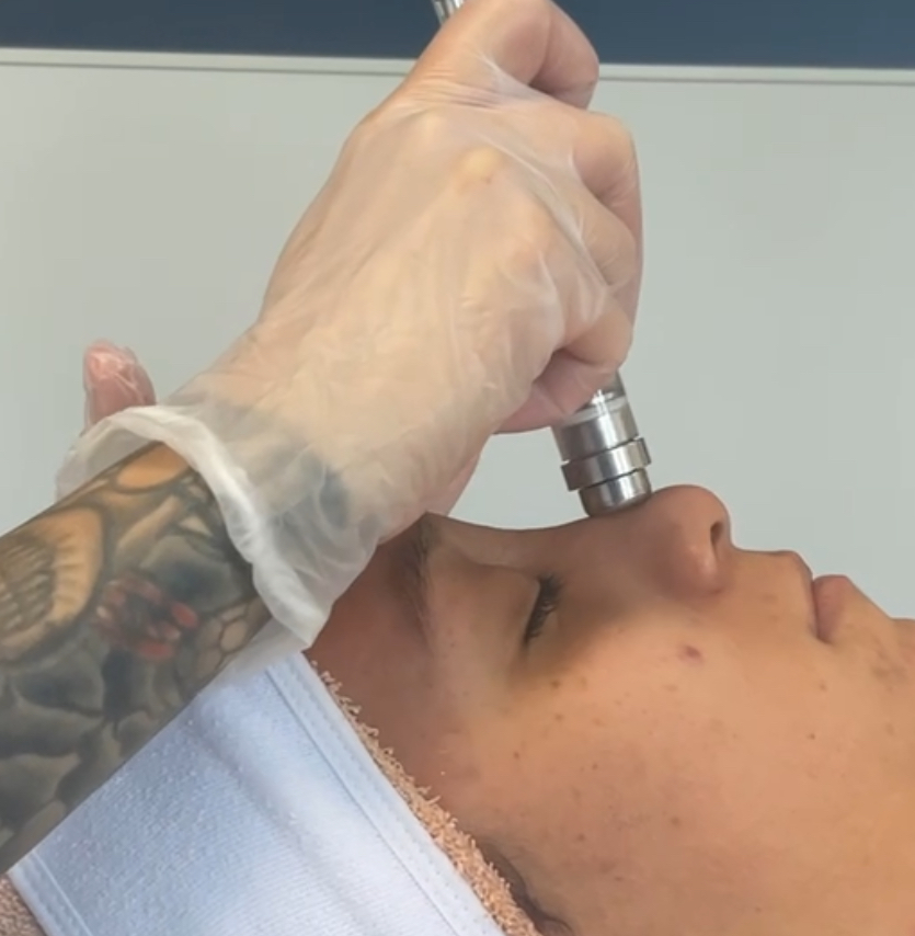 Hydro Facial at A1 Aesthetics LLC in Hudson, NY
