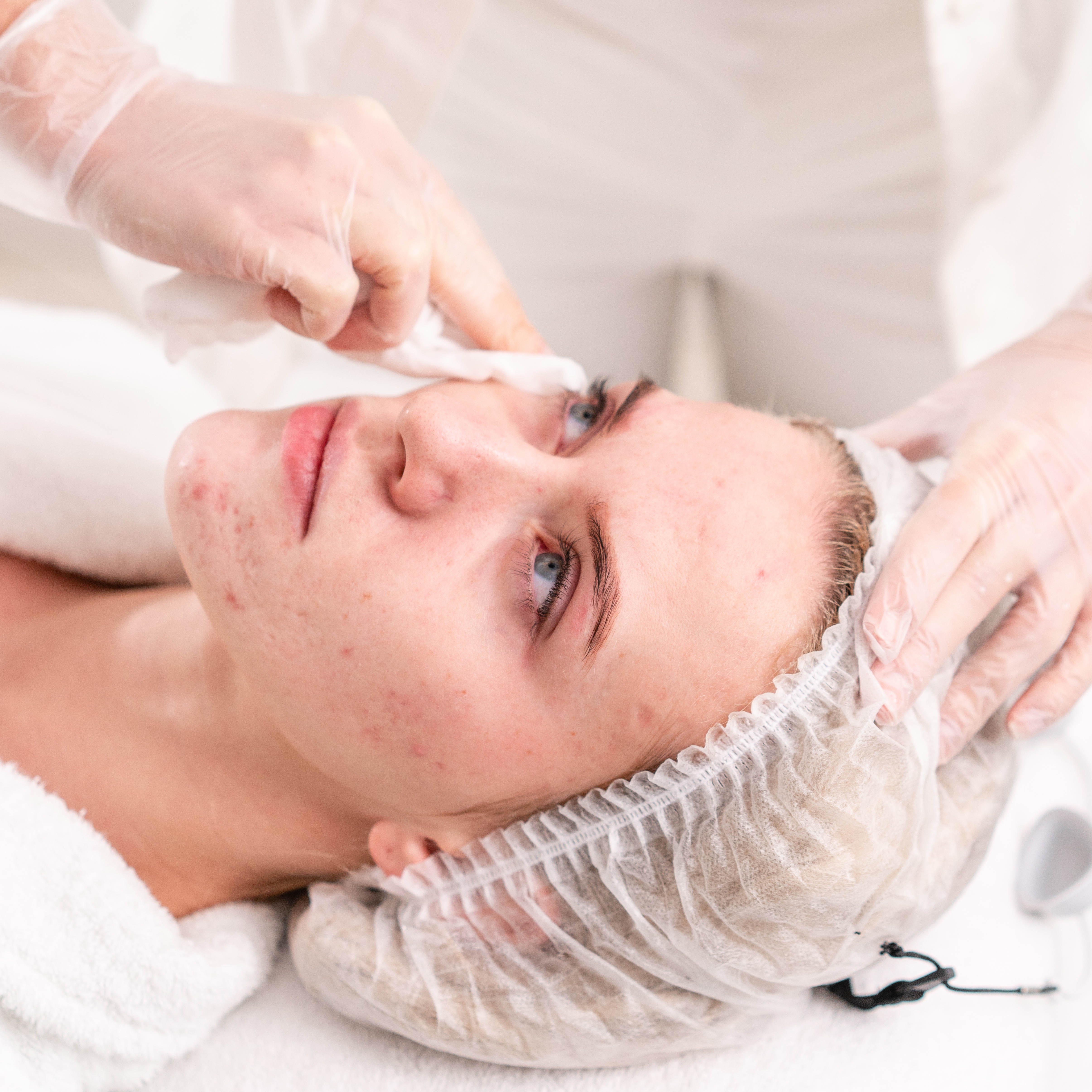 Acne Clearing Laser Facial at 360 Med Spa Buford in Buford, GA