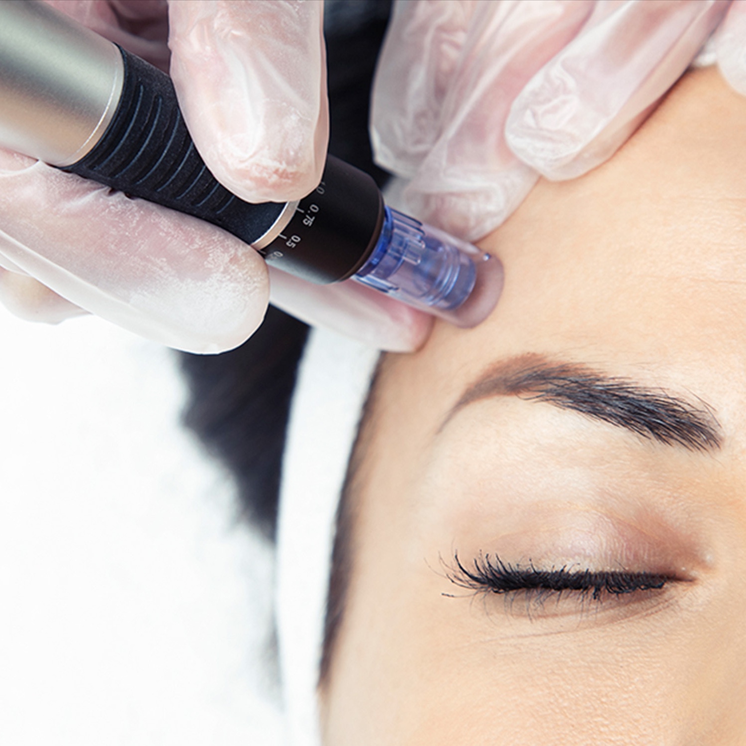 Microneedling