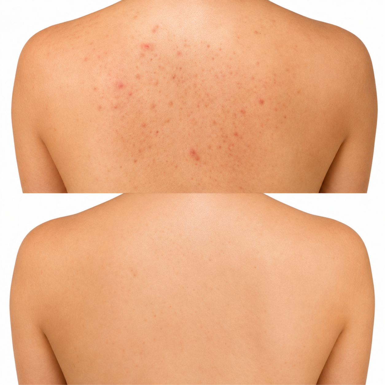 AC DUAL Back Acne Treatment at Skin Corrective Aesthetics in Dallas, TX