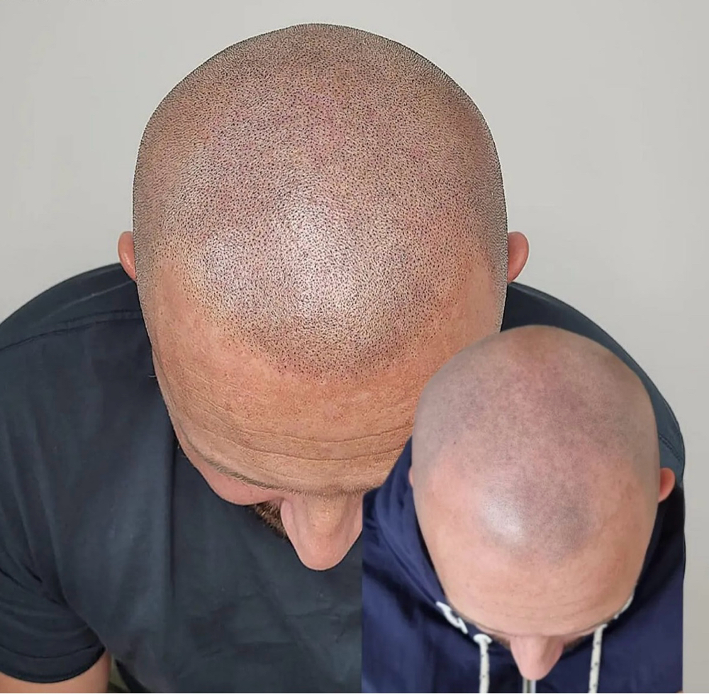 SMP: Scalp micropigmentation