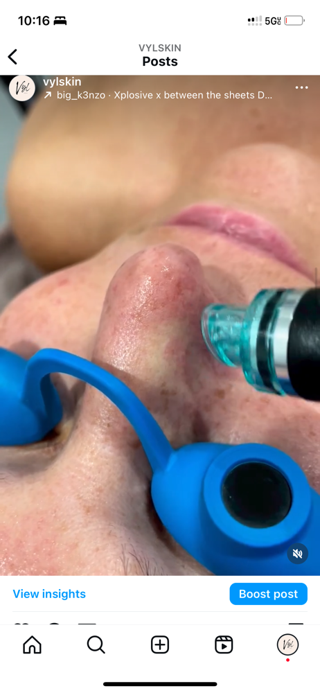 Acne Hydrafacial