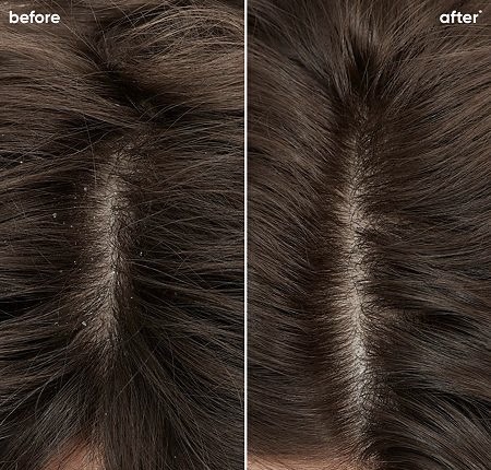 Scalp Treatment